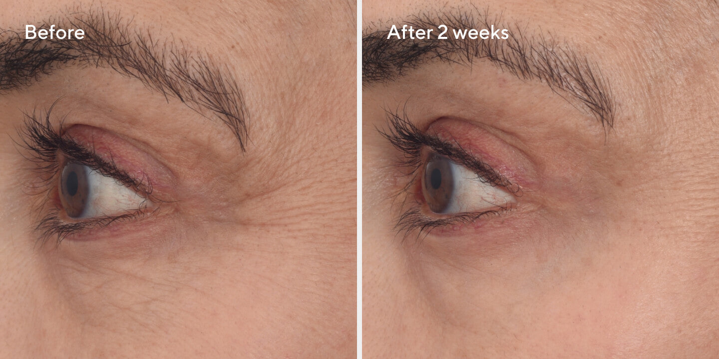 Retinal Resculpt Eye Treatment B&A 2