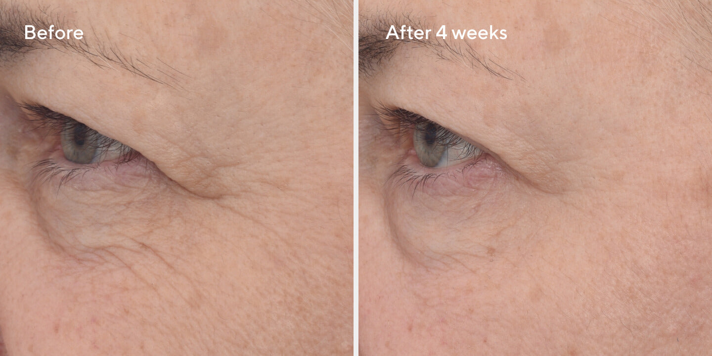 Retinal Resculpt Eye Treatment B&A 3