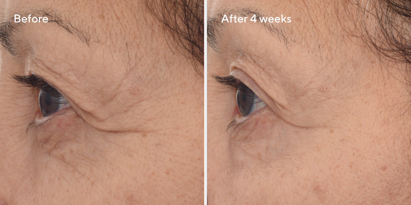 Retinal Resculpt Eye Treatment B&A 4