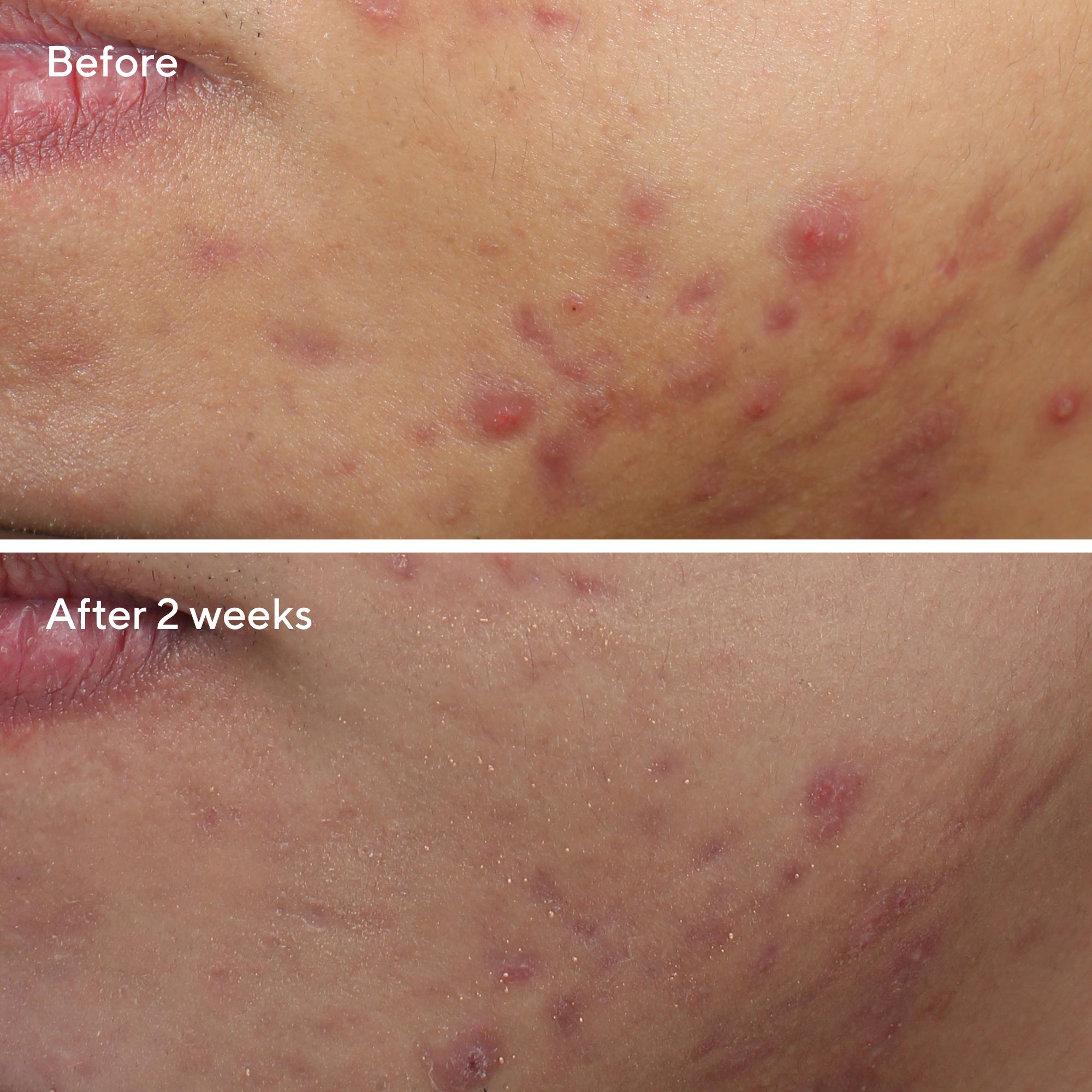 Deep Relief Acne Treatment